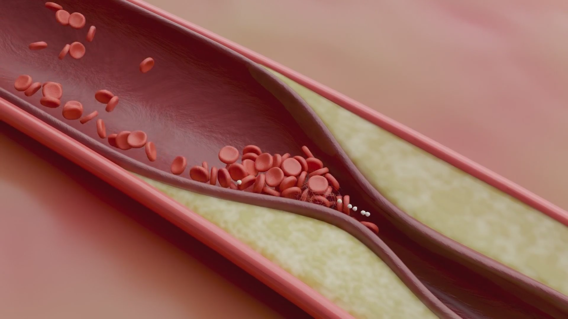Tackling high cholesterol with Dr. Dharmesh Patel of Stern Cardiovascular
