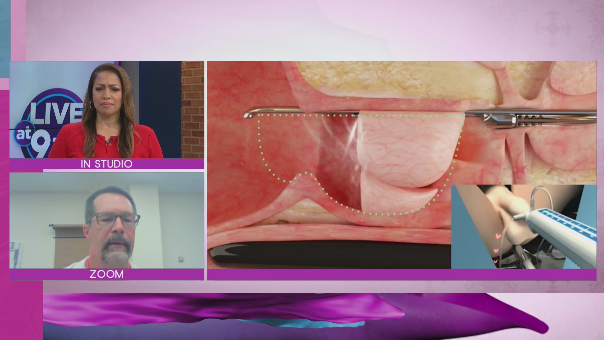 Aquablation for enlarged prostate being used at at Memphis hospital