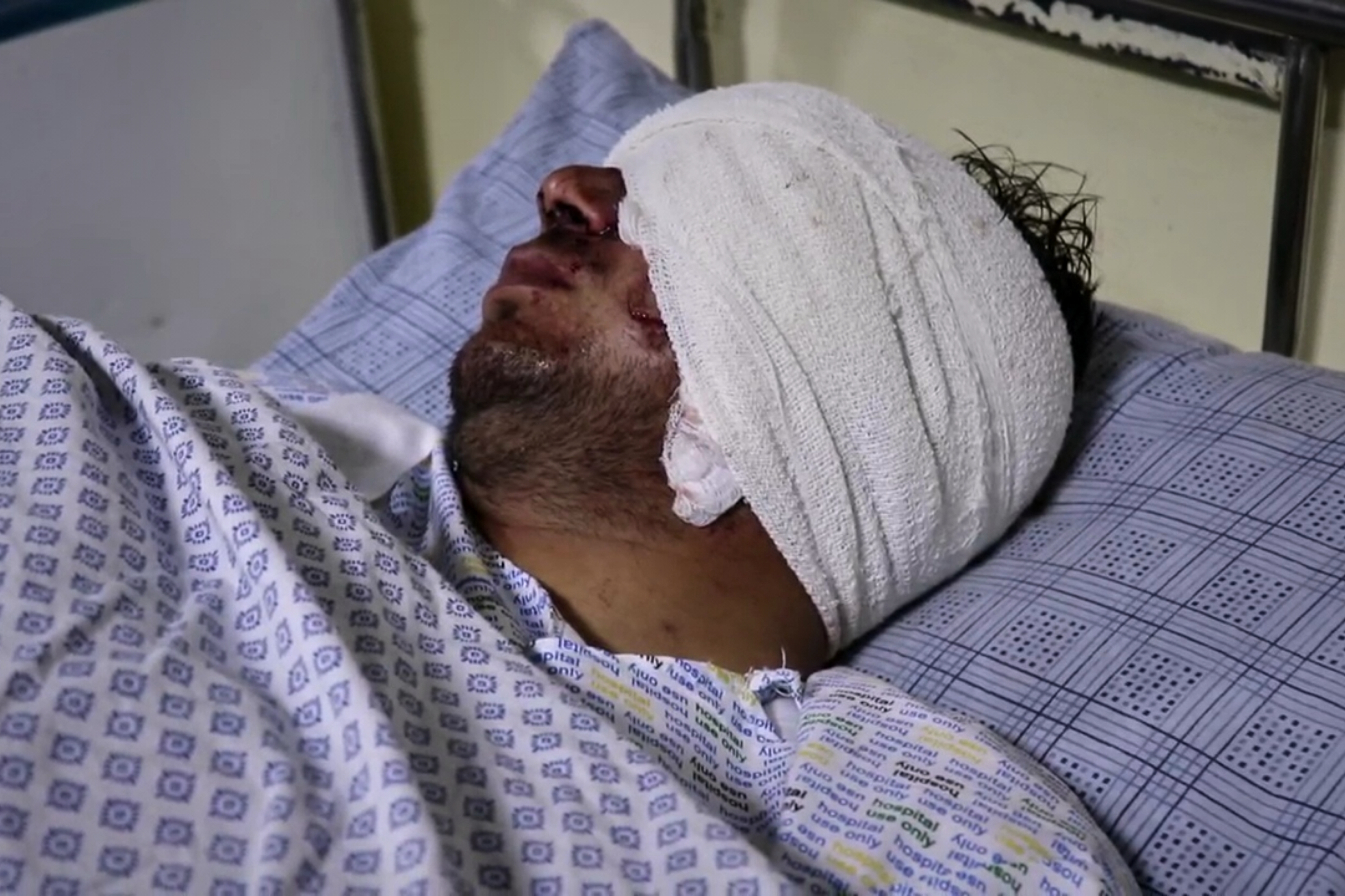 Cricketer Mira Jan lies wounded in a hospital bed after a Pakistani cross-border airstrike that killed several people, including three other local cricketers, at the regional hospital in Afghanistan's eastern Paktika province, Saturday, Oct. 18, 2025. (AP Photo/Shafiqullah Mashaal)